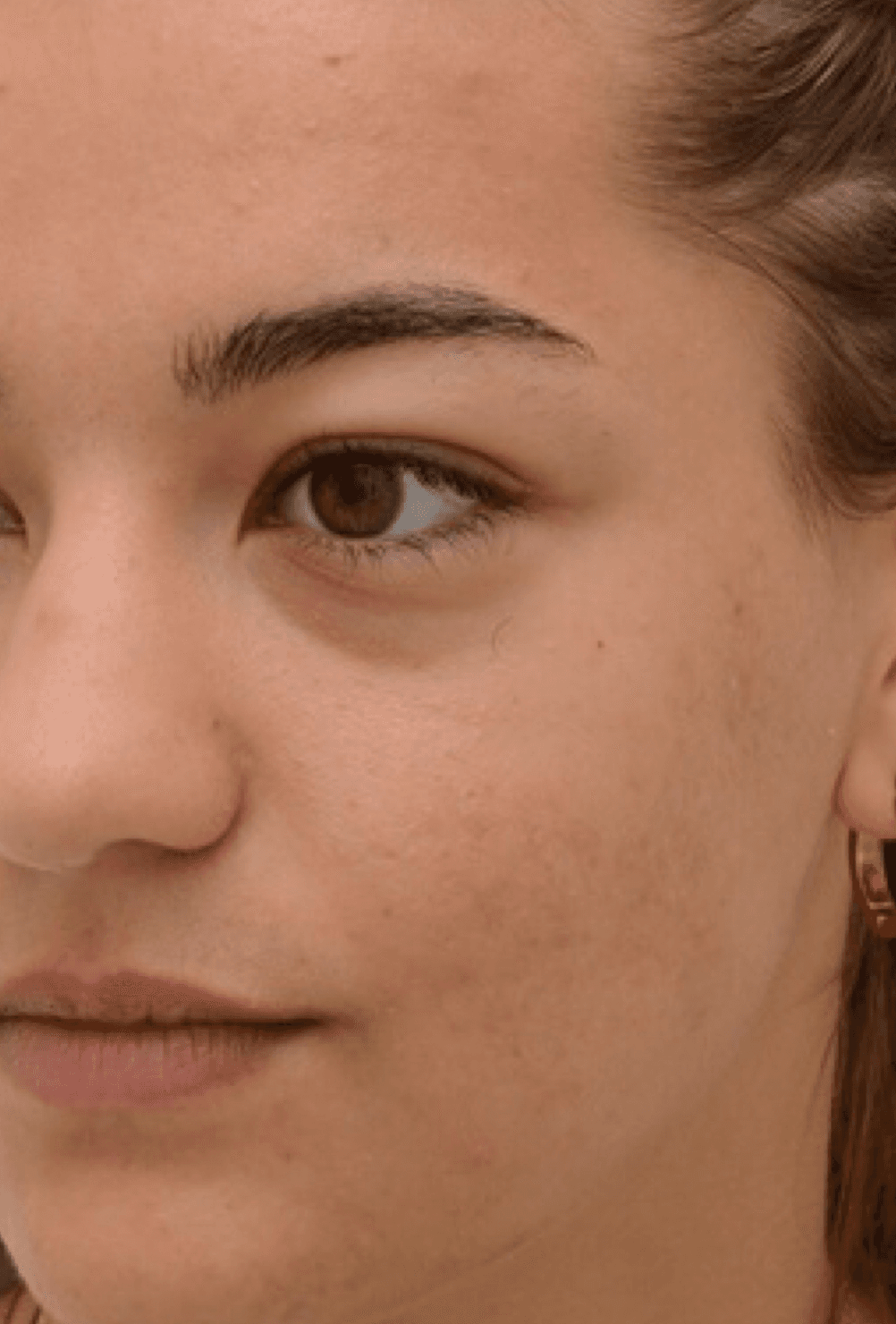 acne-therapy-after