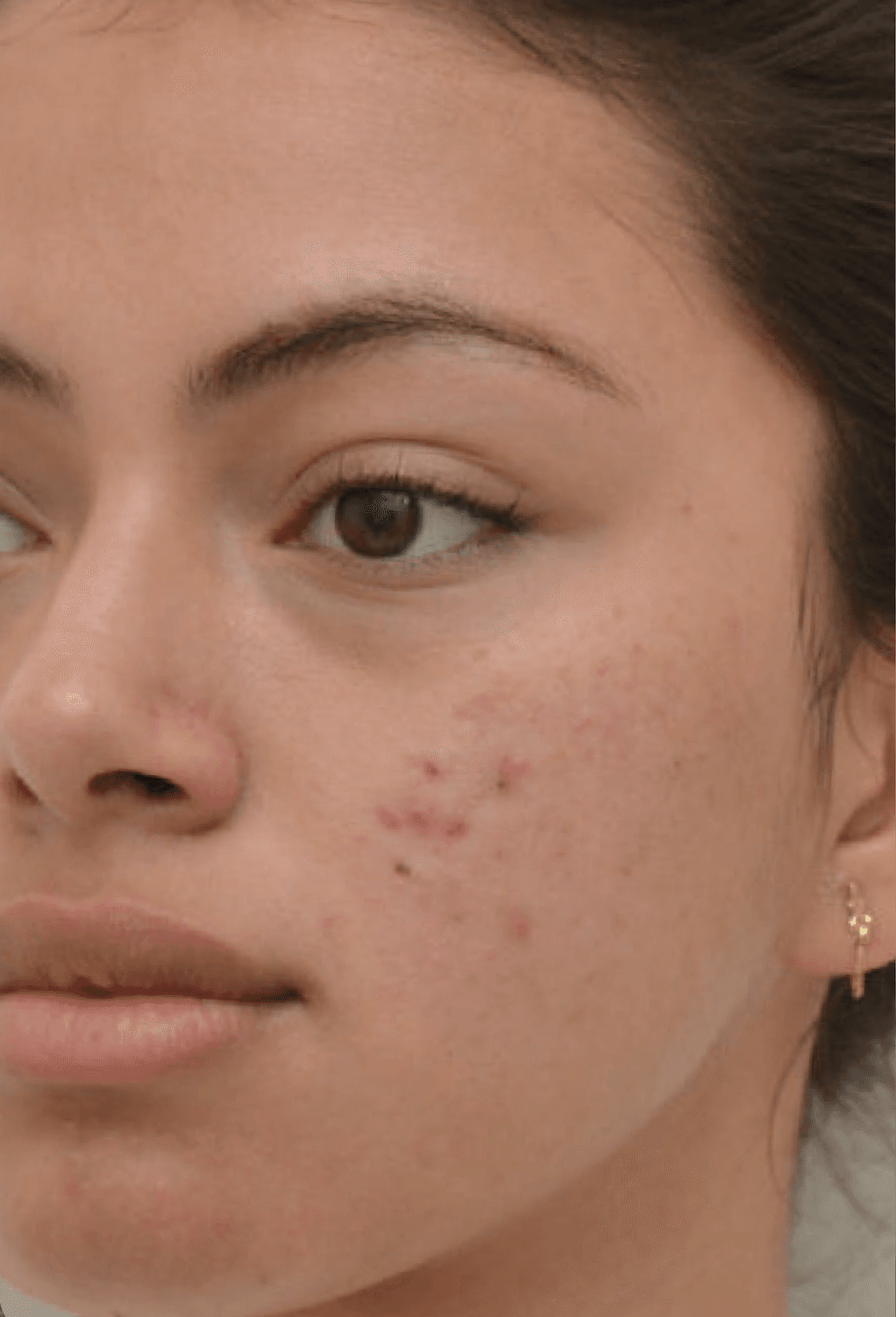 microneedling-before