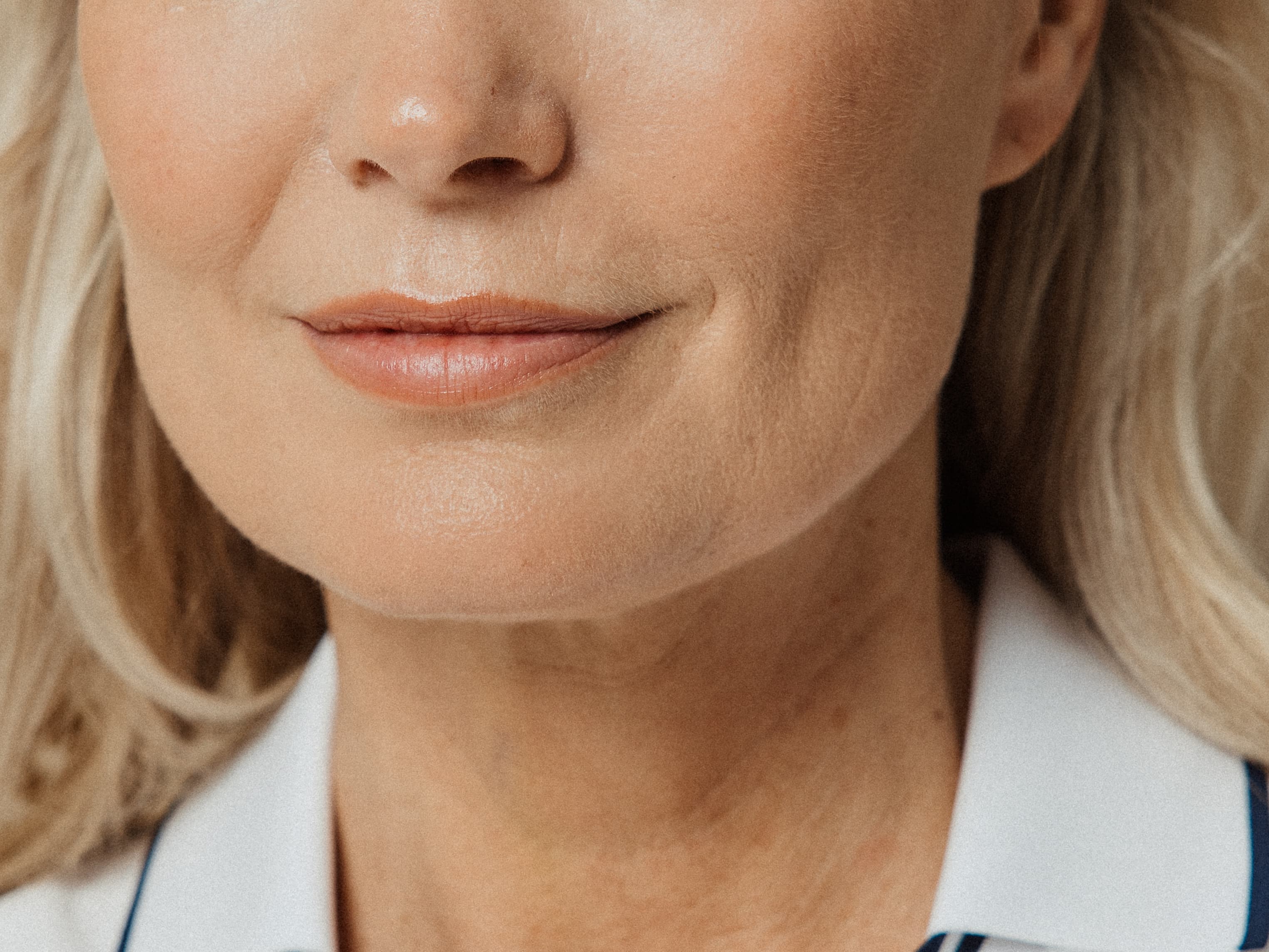 surgical-lip-lift-1