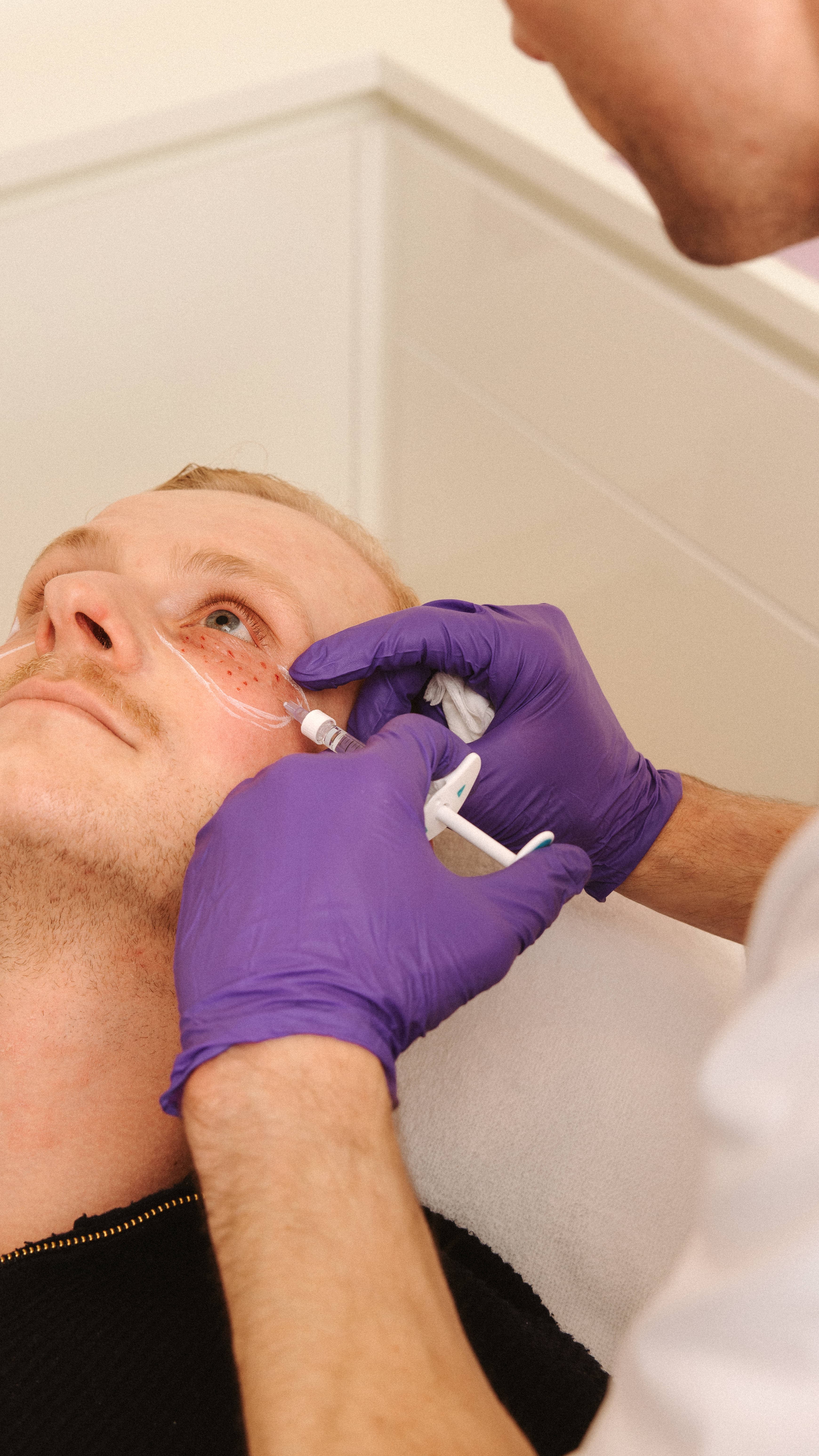 Close-up van een arts die met een injectiespuit een behandeling toedient bij de neus en wang van een mannelijke cliënt