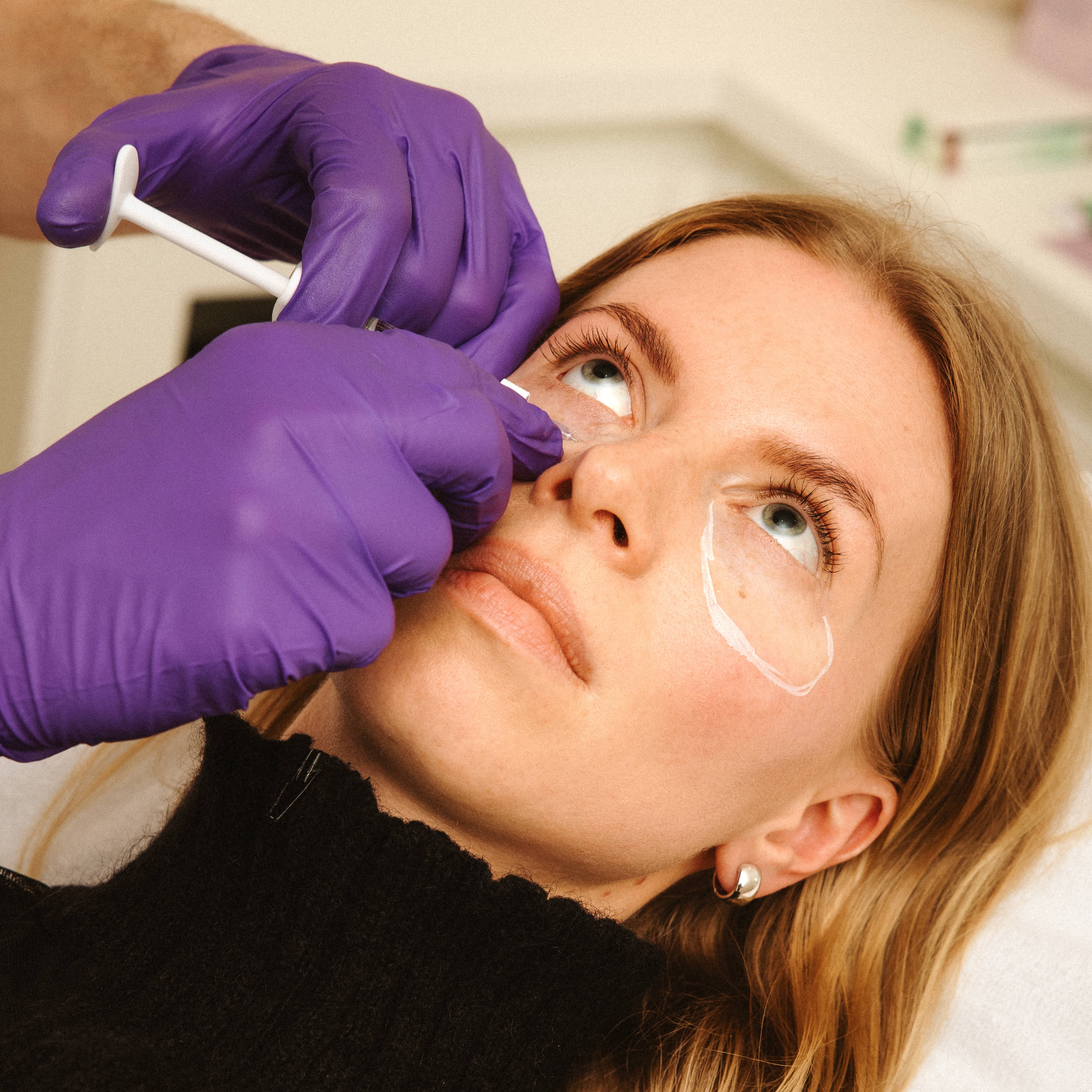 Hyaluronzuur filler voor de wangen bij Soap