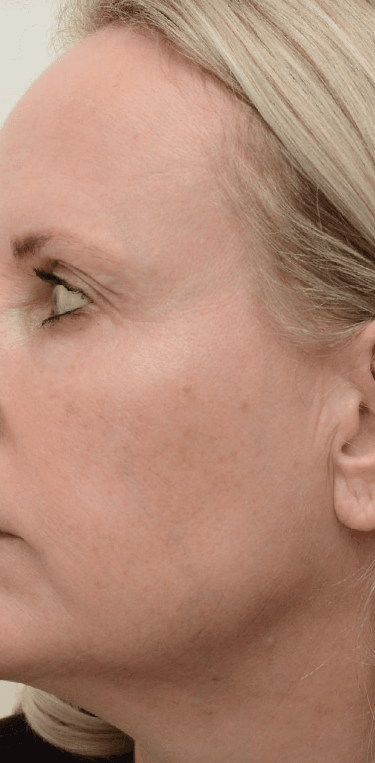 laser-facial-after