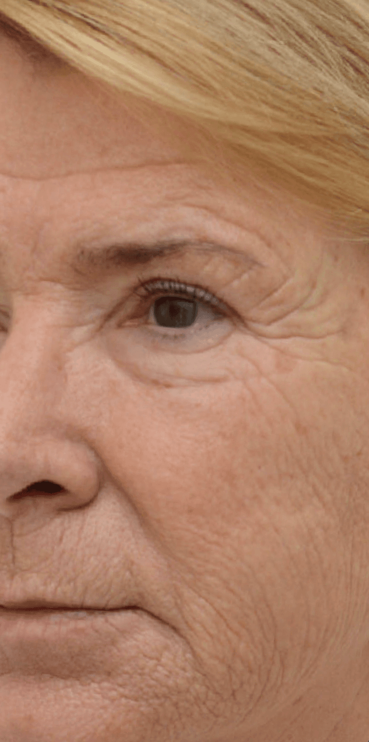 medical-peel-after