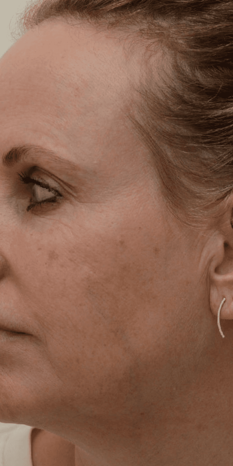 laser-facial-before