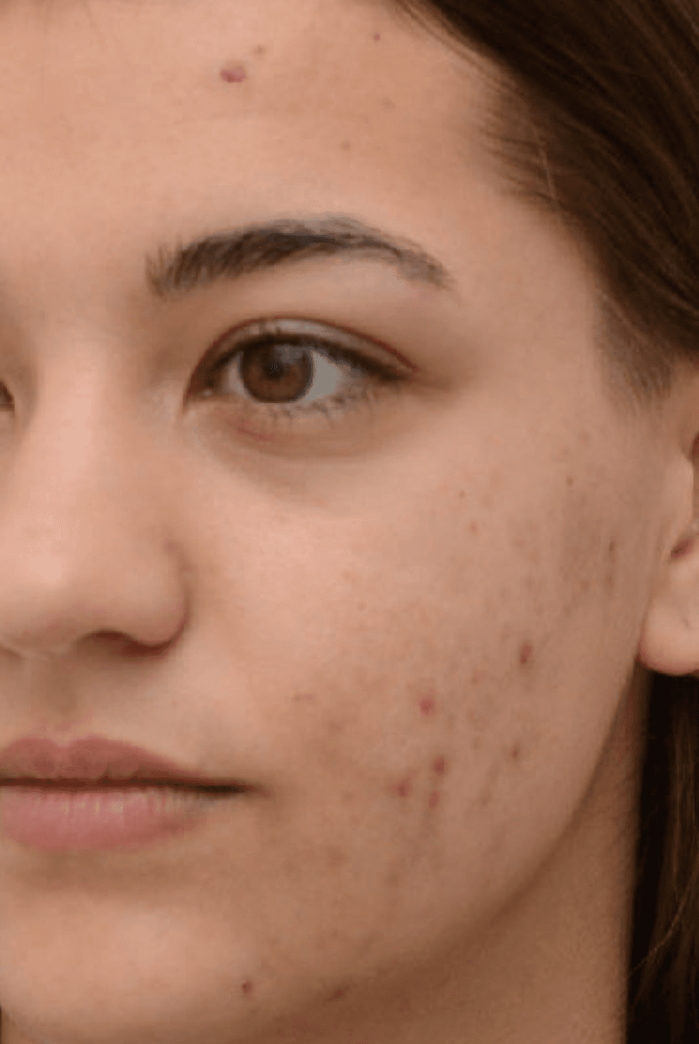 acne-therapy-before